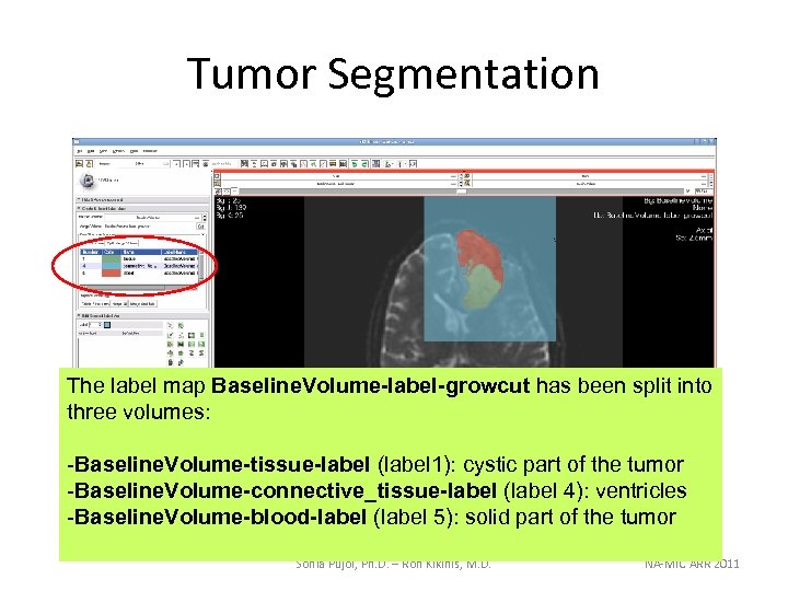 Tumor Segmentation The label map Baseline. Volume-label-growcut has been split into three volumes: -Baseline.