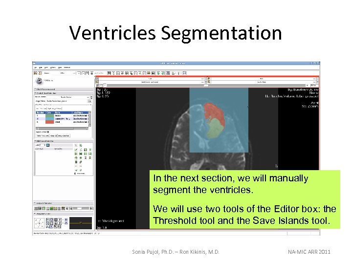 Ventricles Segmentation In the next section, we will manually segment the ventricles. We will