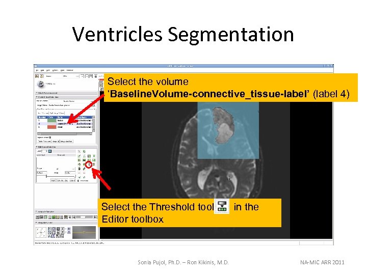 Ventricles Segmentation Select the volume ‘Baseline. Volume-connective_tissue-label’ (label 4) Select the Threshold tool Editor