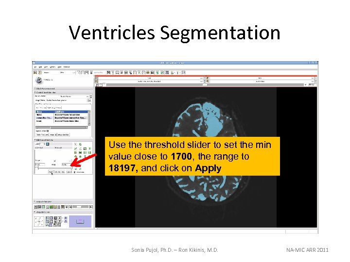 Ventricles Segmentation Use threshold slider to set the min value close to 1700, the