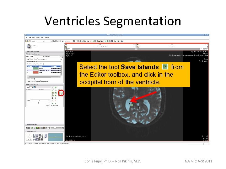 Ventricles Segmentation Select the tool Save Islands from the Editor toolbox, and click in