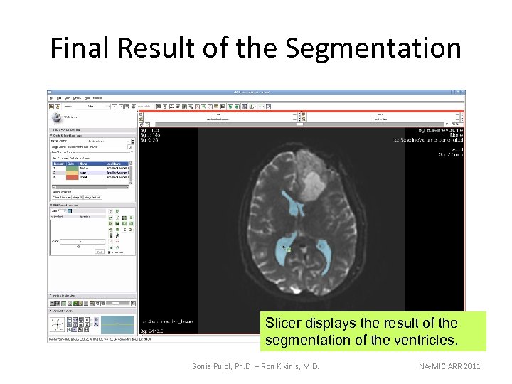 Final Result of the Segmentation Slicer displays the result of the segmentation of the