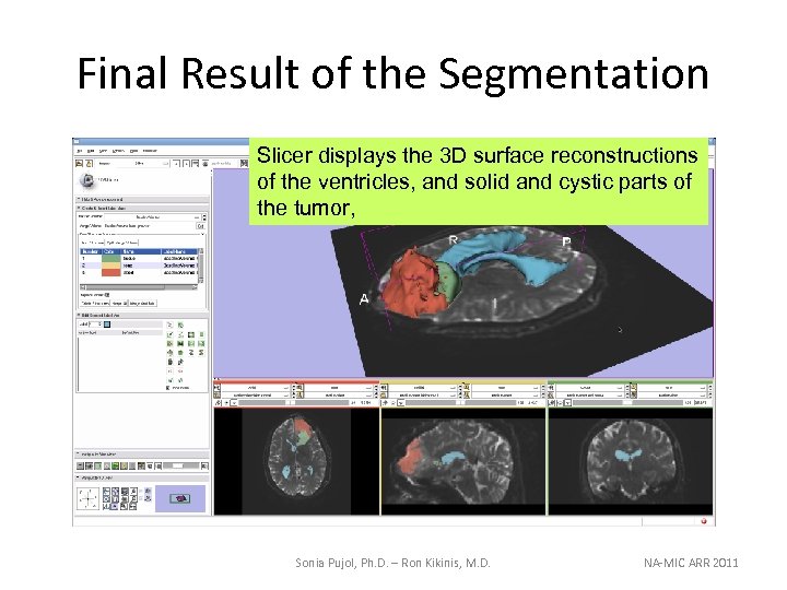 Final Result of the Segmentation Slicer displays the 3 D surface reconstructions of the