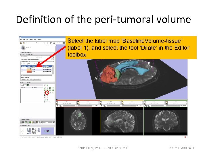 Definition of the peri-tumoral volume Select the label map ‘Baseline. Volume-tissue’ (label 1), and