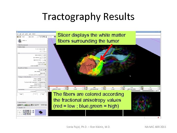 Tractography Results Slicer displays the white matter fibers surrounding the tumor The fibers are