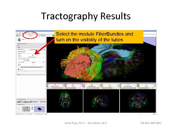 Tractography Results Select the module Fiber. Bundles and turn on the visibility of the