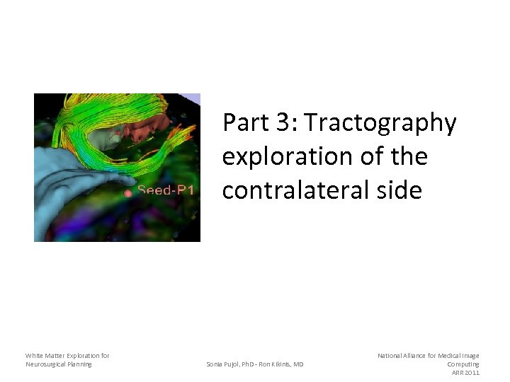 Part 3: Tractography exploration of the contralateral side White Matter Exploration for Neurosurgical Planning