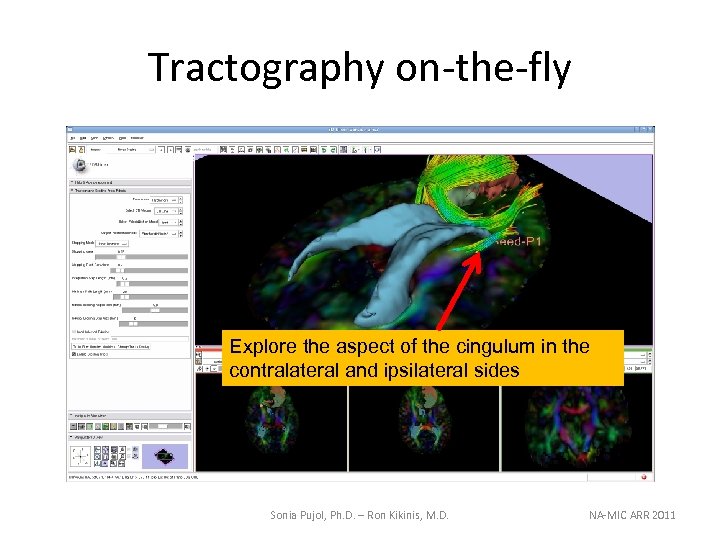Tractography on-the-fly Explore the aspect of the cingulum in the contralateral and ipsilateral sides