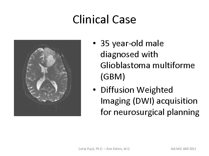 Clinical Case • 35 year-old male diagnosed with Glioblastoma multiforme (GBM) • Diffusion Weighted
