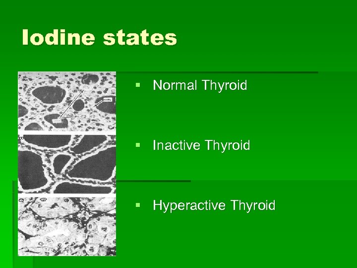 Iodine states § Normal Thyroid § Inactive Thyroid § Hyperactive Thyroid 