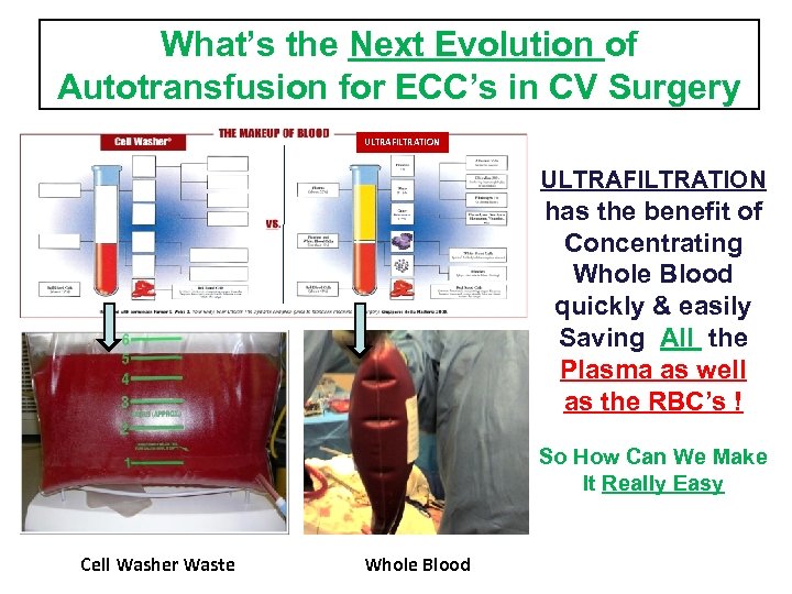 What’s the Next Evolution of Autotransfusion for ECC’s in CV Surgery ULTRAFILTRATION has the
