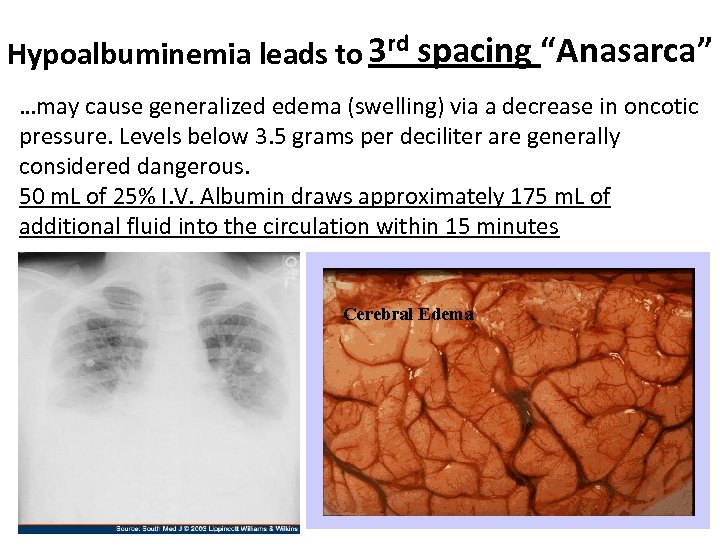 Hypoalbuminemia leads to 3 rd spacing “Anasarca” …may cause generalized edema (swelling) via a