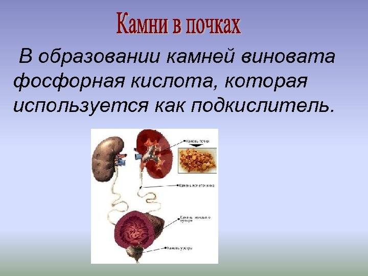 В образовании камней виновата фосфорная кислота, которая используется как подкислитель. 