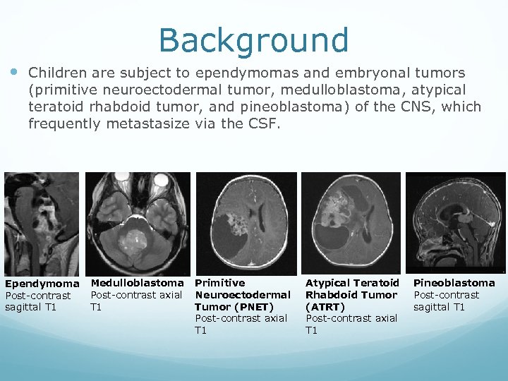 Background Children are subject to ependymomas and embryonal tumors (primitive neuroectodermal tumor, medulloblastoma, atypical