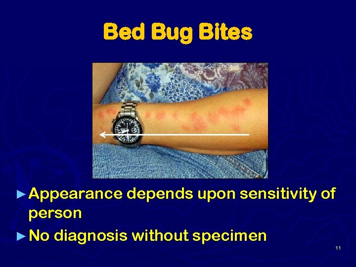 Bed Bug Bites ► Appearance depends upon sensitivity of person ► No diagnosis without