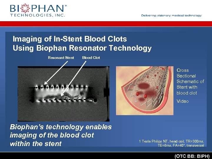Imaging of In-Stent Blood Clots Using Biophan Resonator Technology Resonant Stent Blood Clot Cross