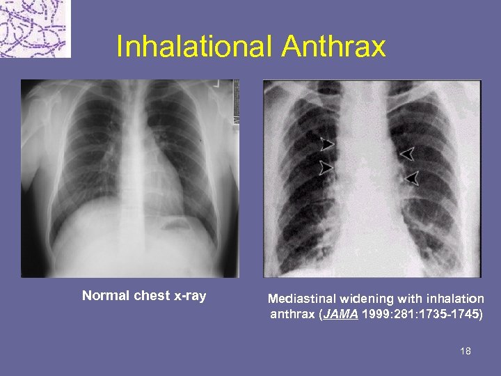 Inhalational Anthrax Normal chest x-ray Mediastinal widening with inhalation anthrax (JAMA 1999: 281: 1735