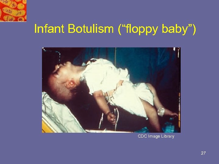 Infant Botulism (“floppy baby”) CDC Image Library 27 