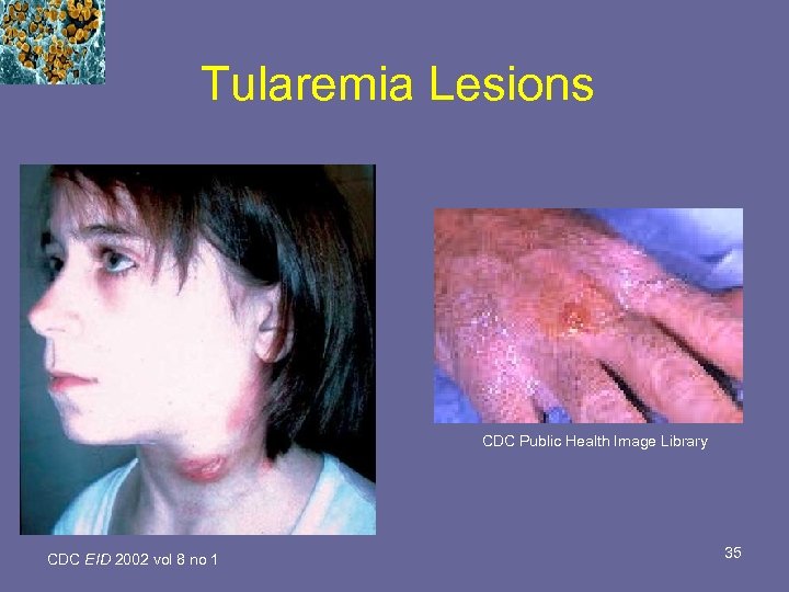 Tularemia Lesions CDC Public Health Image Library CDC EID 2002 vol 8 no 1