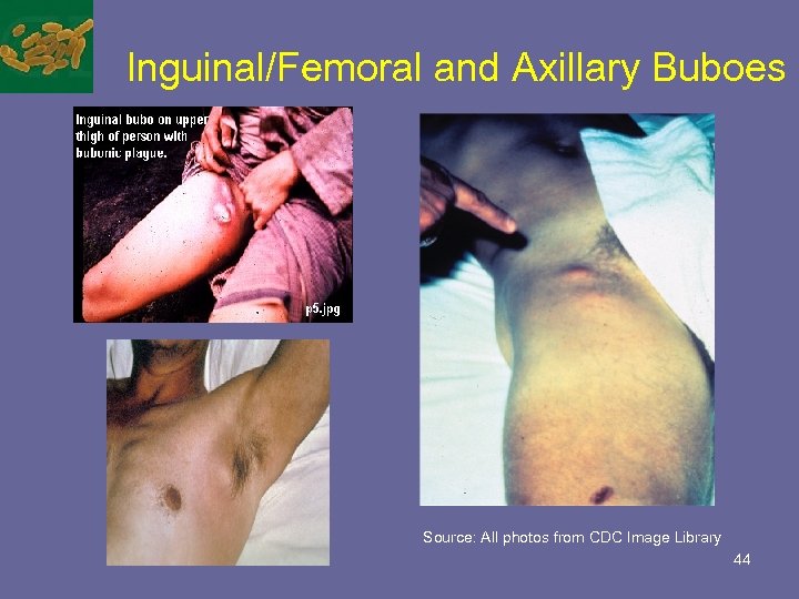 Inguinal/Femoral and Axillary Buboes Source: All photos from CDC Image Library 44 