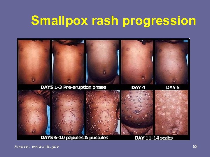 Smallpox rash progression Source: www. cdc. gov 53 