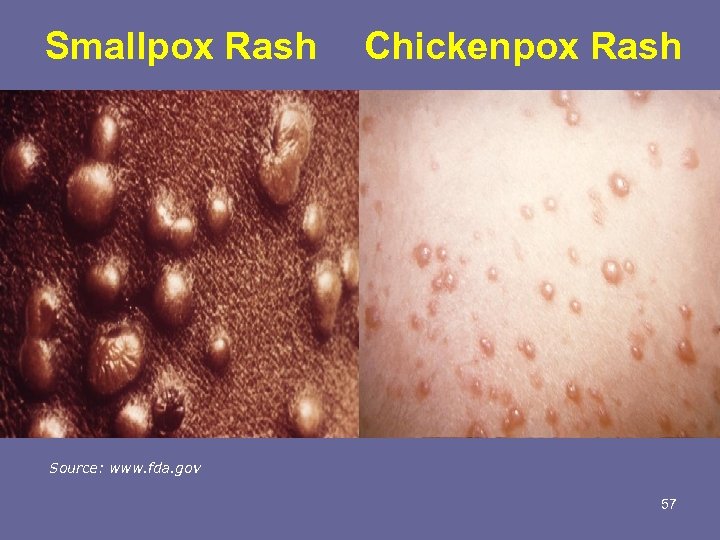 Smallpox Rash Chickenpox Rash Source: www. fda. gov 57 
