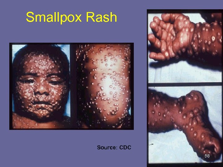Smallpox Rash Source: CDC 58 