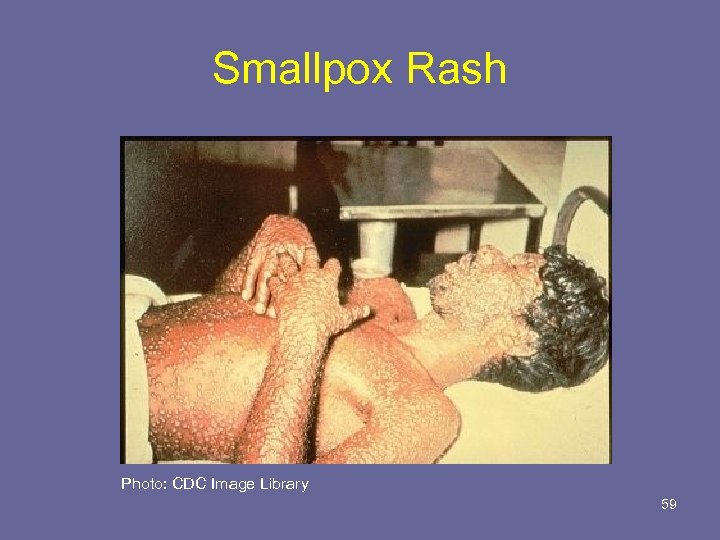 Smallpox Rash Photo: CDC Image Library 59 