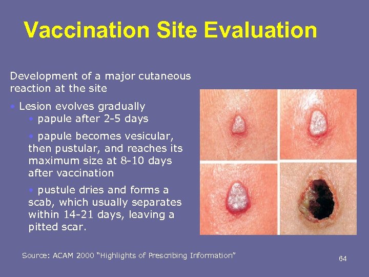 Vaccination Site Evaluation Development of a major cutaneous reaction at the site • Lesion