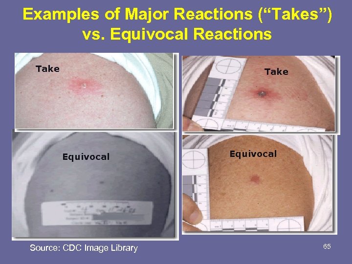 Examples of Major Reactions (“Takes”) vs. Equivocal Reactions Take Equivocal Source: CDC Image Library
