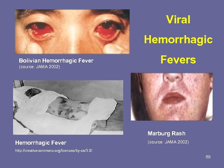 Viral Hemorrhagic Bolivian Hemorrhagic Fever (source: JAMA 2002) Fevers Marburg Rash Hemorrhagic Fever (source: