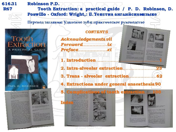 616. 31 R 67 Robinson P. D. Tooth Extraction: a practical guide / P.