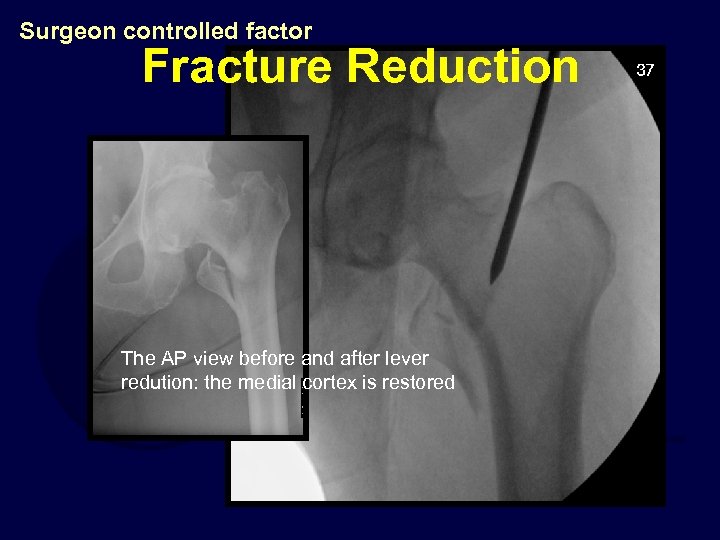 Intertrochanteric Fractures Presenter Please Look At Notes To