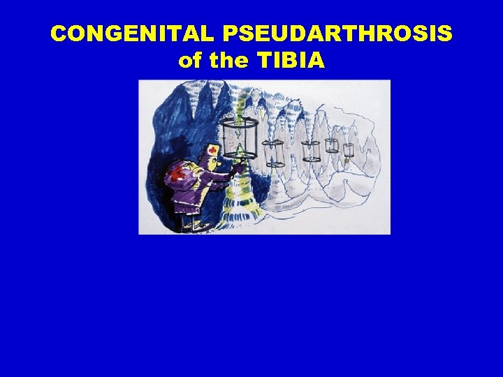 CONGENITAL PSEUDARTHROSIS of the TIBIA 