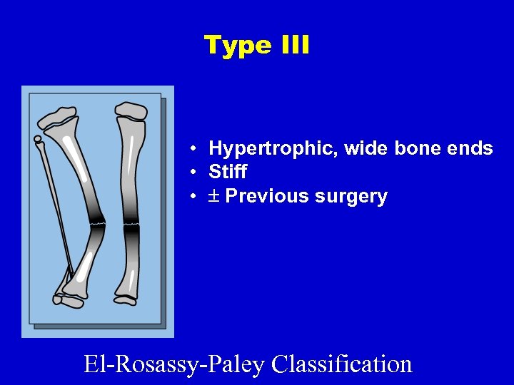 Type III • Hypertrophic, wide bone ends • Stiff • Previous surgery El-Rosassy-Paley Classification