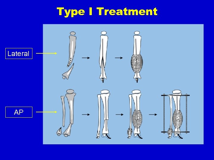 Type I Treatment Lateral AP 