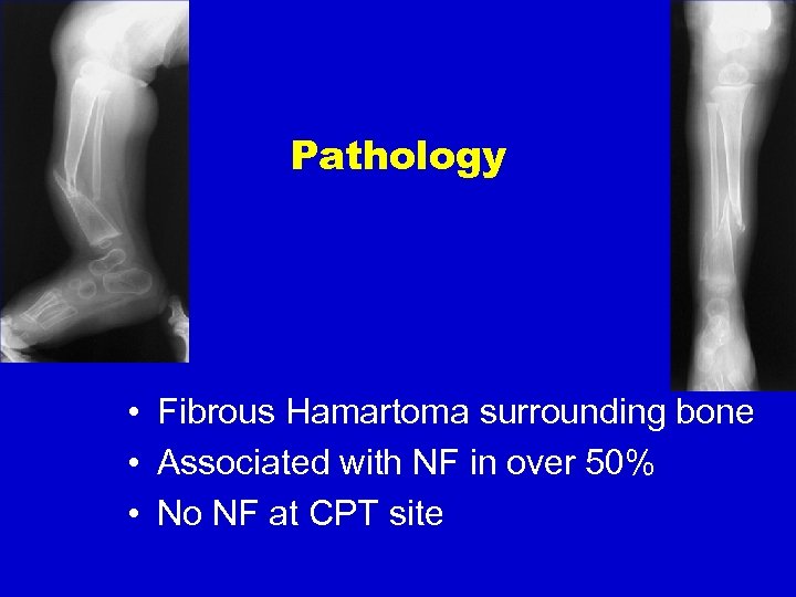Pathology • Fibrous Hamartoma surrounding bone • Associated with NF in over 50% •