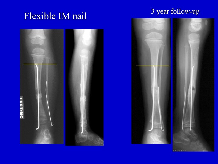 Flexible IM nail 3 year follow-up 