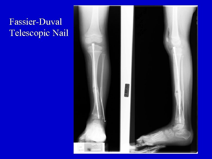 Fassier-Duval Telescopic Nail 