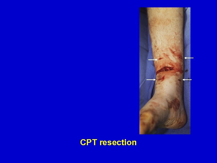 CPT resection 