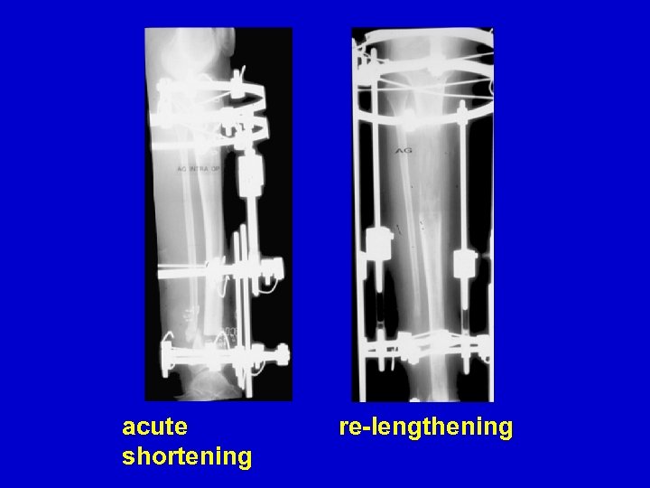 acute shortening re-lengthening 