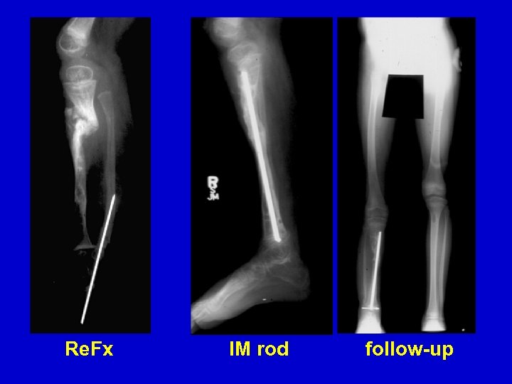 Re. Fx IM rod follow-up 
