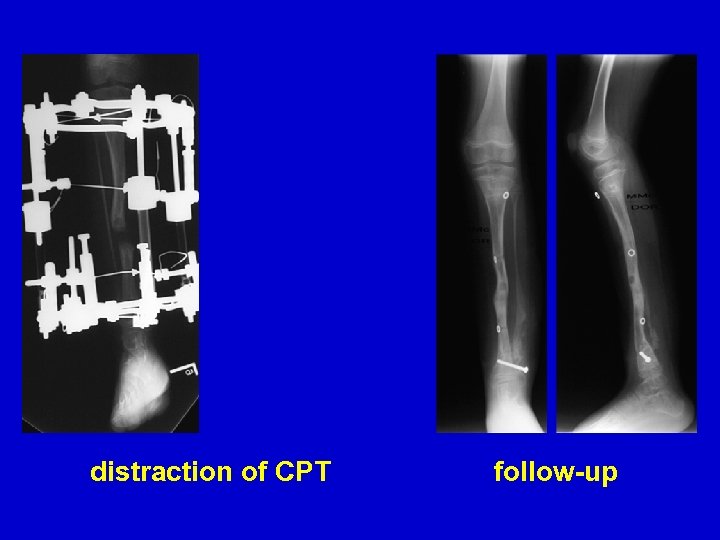 distraction of CPT follow-up 