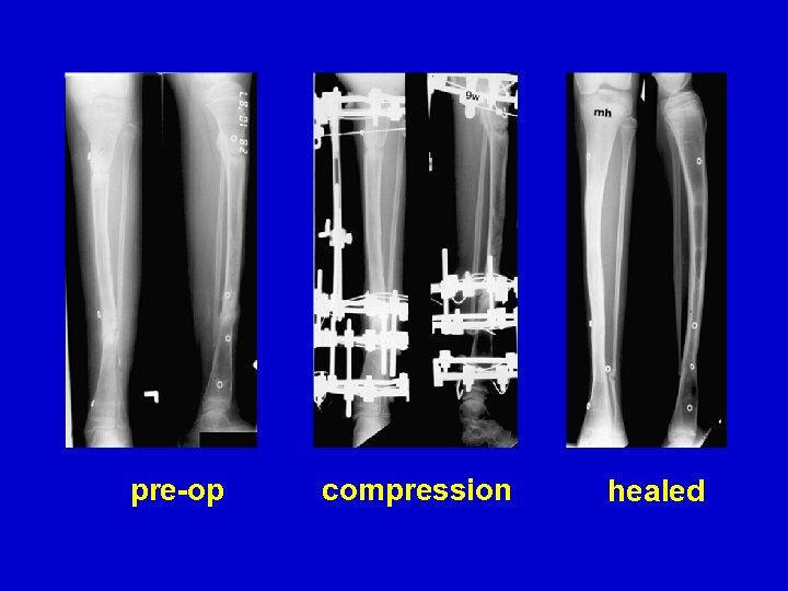 pre-op compression healed 