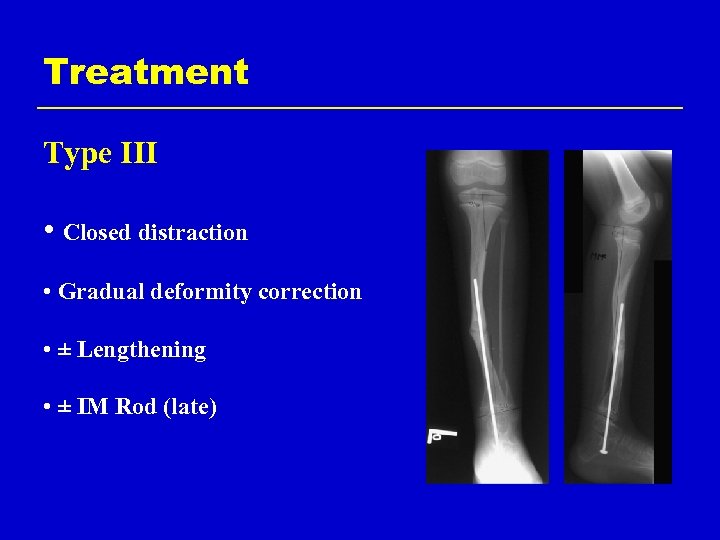 Treatment Type III • Closed distraction • Gradual deformity correction • ± Lengthening •