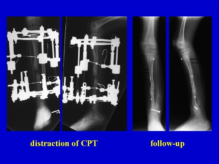 distraction of CPT follow-up 