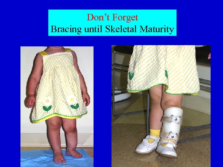 Don’t Forget Bracing until Skeletal Maturity 