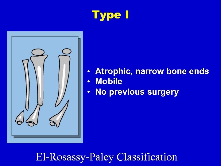Type I • Atrophic, narrow bone ends • Mobile • No previous surgery El-Rosassy-Paley
