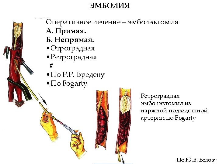 ЭМБОЛИЯ Оперативное лечение – эмболэктомия А. Прямая. Б. Непрямая. • Отроградная • Ретроградная #