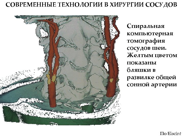 СОВРЕМЕННЫЕ ТЕХНОЛОГИИ В ХИРУРГИИ СОСУДОВ Спиральная компьютерная томография сосудов шеи. Желтым цветом показаны бляшки